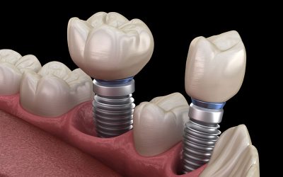 Can an emergency dentist treat a broken dental implant?