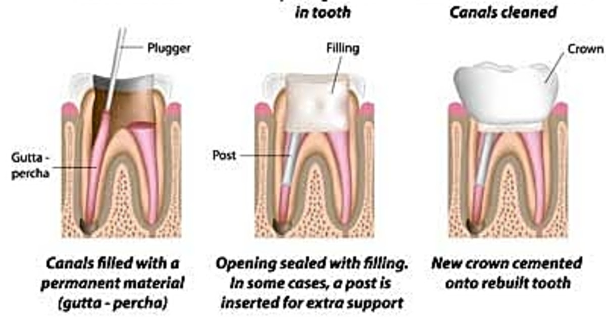 Can an emergency dentist perform a root canal?