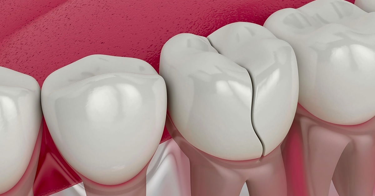 Can an emergency dentist treat a cracked tooth?