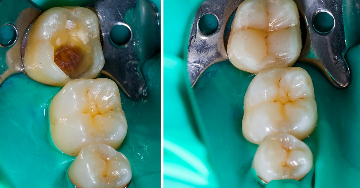 Can an emergency dentist treat a lost filling or crown?