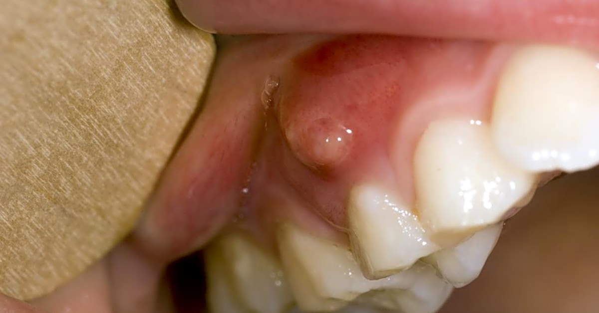 Are there any home remedies for gum infections or abscesses that can help until i can get to the dentist?