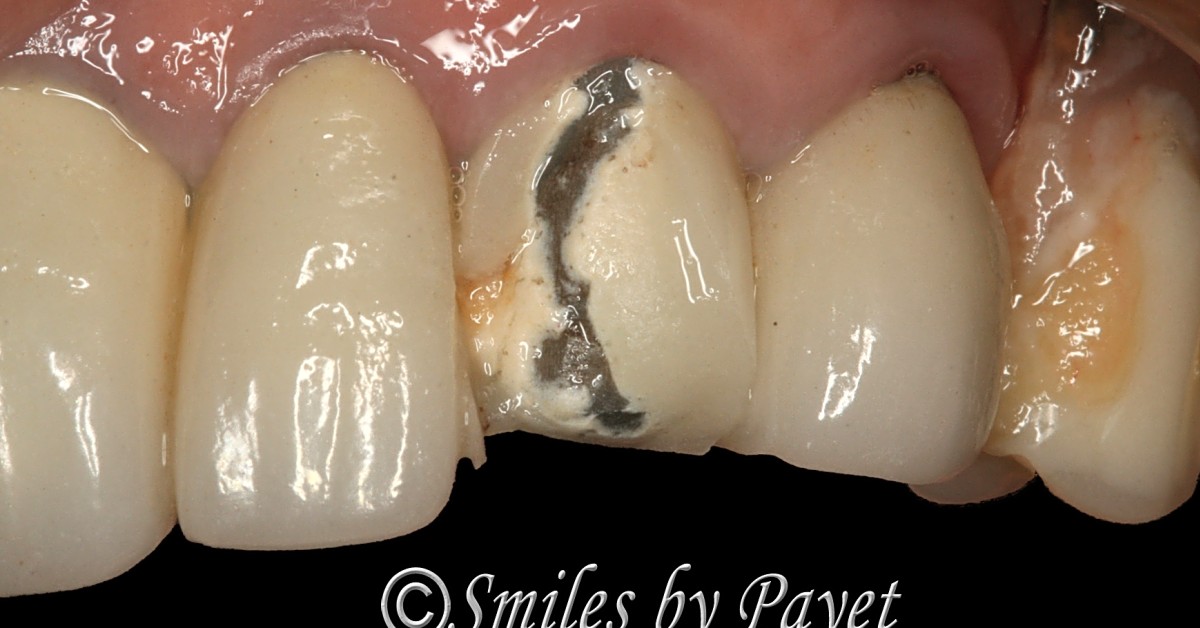 Can a broken dental bridge be fixed?