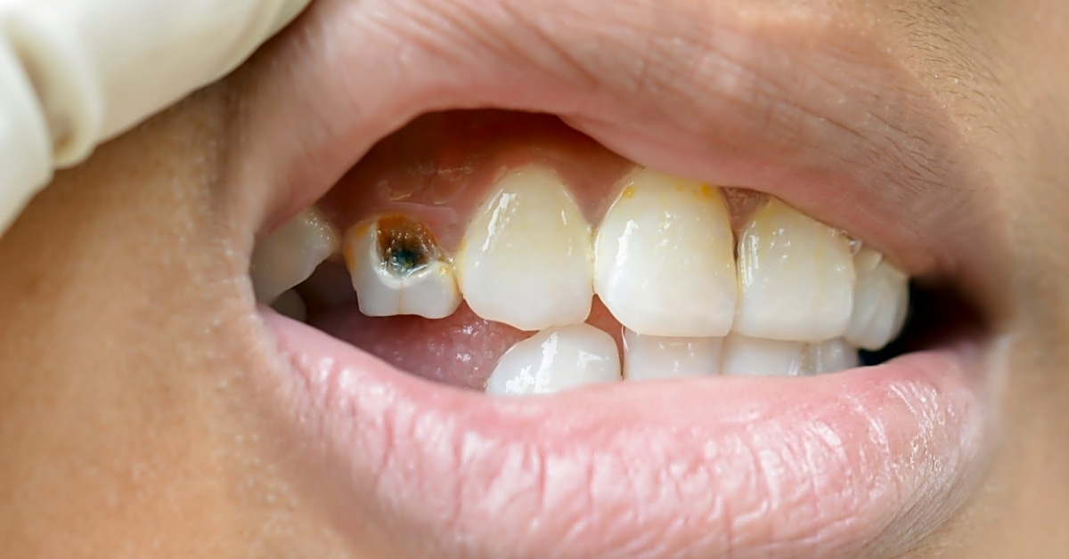 What should i do if my tooth is cracked or chipped in an accident?