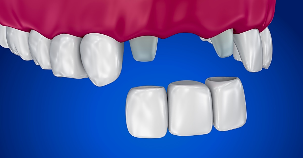 Are there any home remedies for lost fillings or crowns that can help until i can get to the dentist?