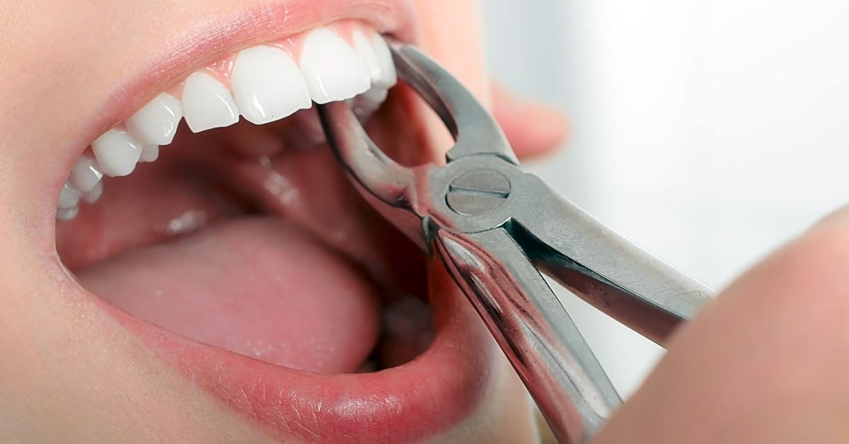 How urgent is a tooth extraction?