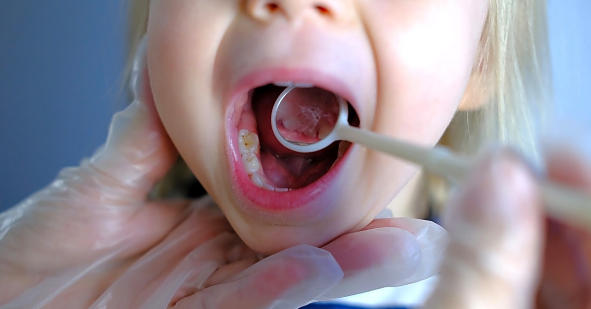 Will a dentist pull an infected tooth the same day?