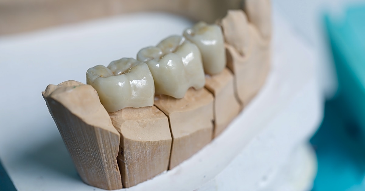 How do you temporarily fix a dental bridge?