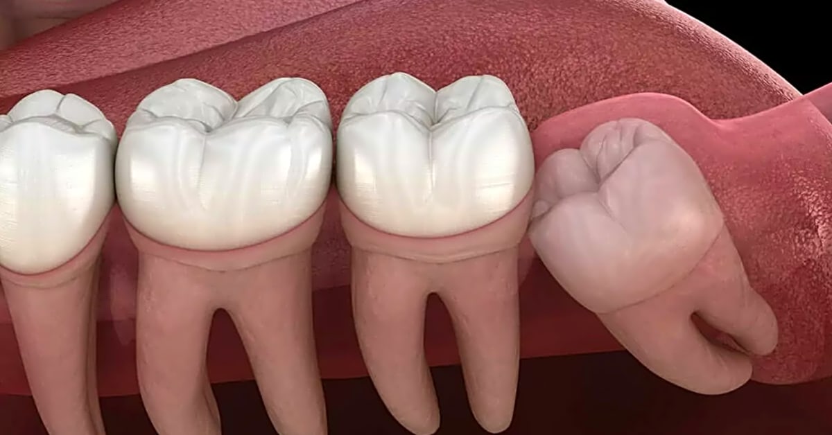 Will an emergency dentist take out a wisdom tooth?